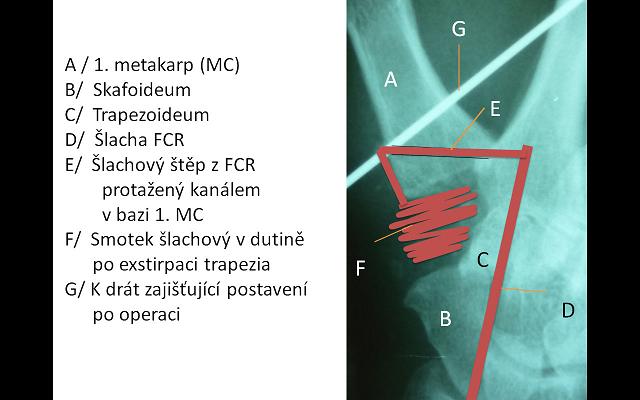 Buton-schema operace