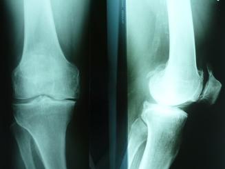 gonartróza 2 stupně kolene