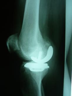 tratarea țesuturilor cartilaginoase ale chondroprotectoarelor de artroză traumatism la meniscul articulației genunchiului cornului