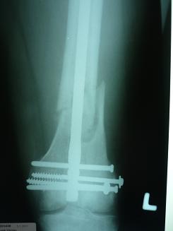 zlomenina dol. konce kosti stehenní po operaci